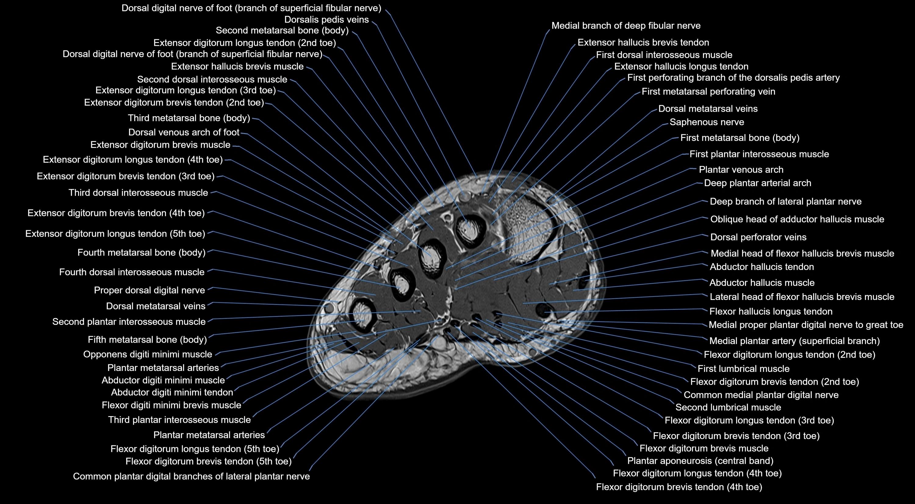 MRI mid foot coronal ligaments cross sectional anatomy 3T  radiology  image-img-00001-00006.webp